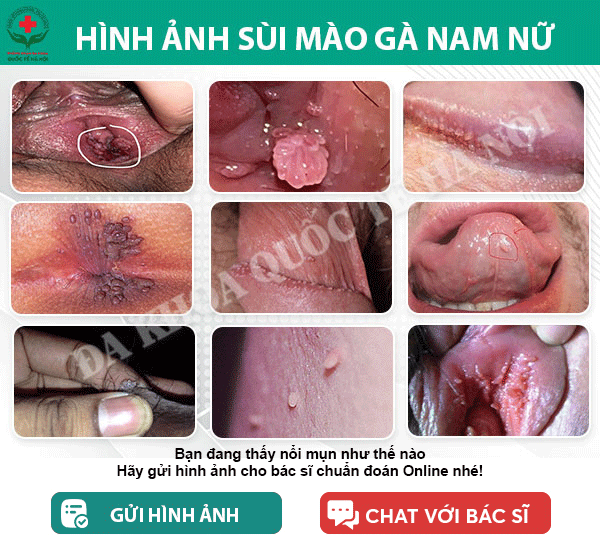 hình ảnh sùi mào gà nam nữ