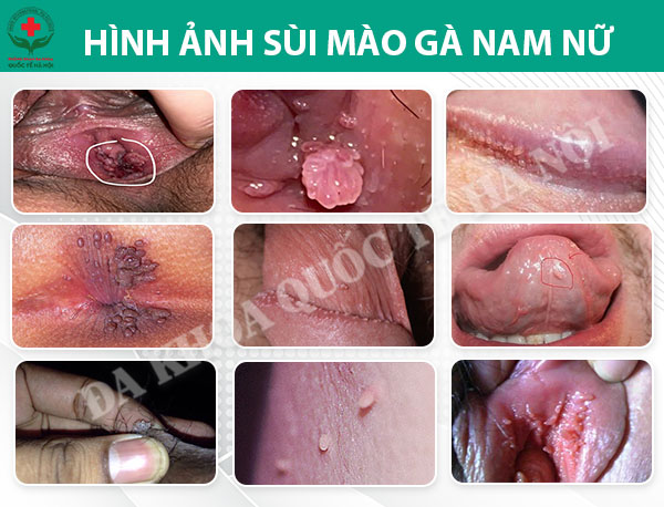 hình aảnh sùi mào gà nam nữ