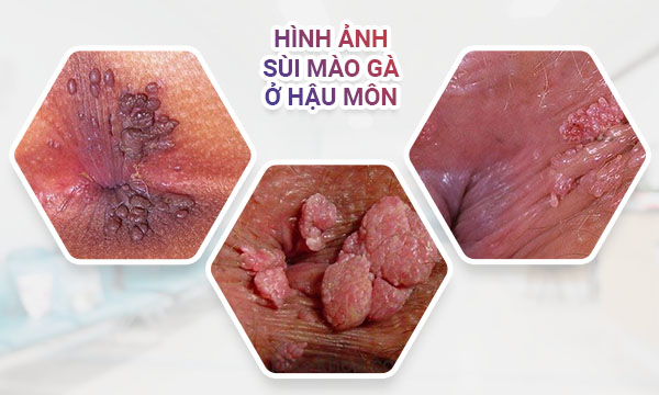 sùi mào gà ở hậu môn