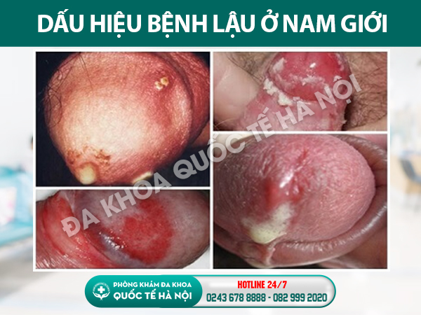 dấu hiệu bệnh lậu ở nam giới