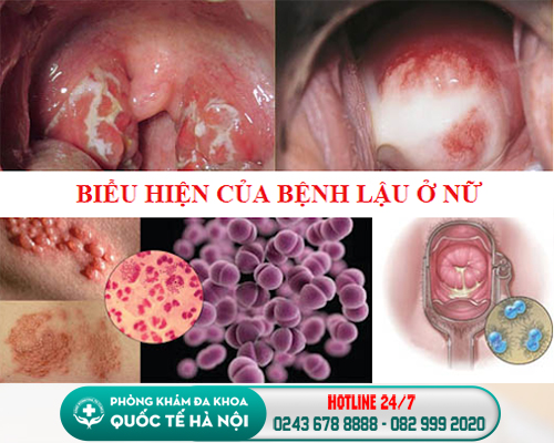 dấu hiệu bệnh lậu ở nữ