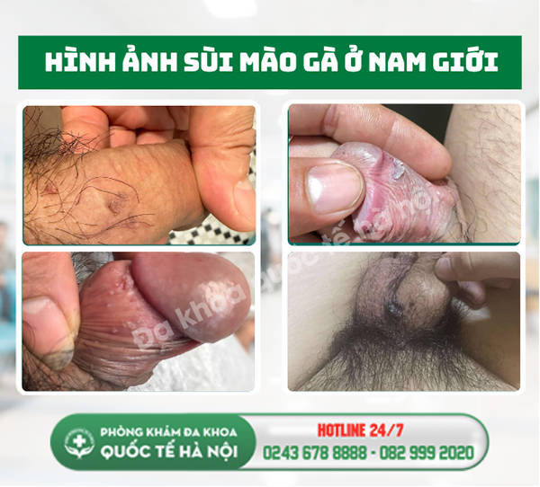 sùi mào gà ở nam