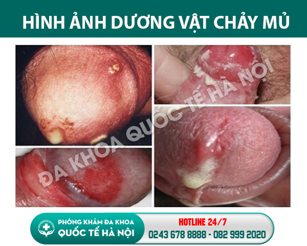 dương vật chảy mủ