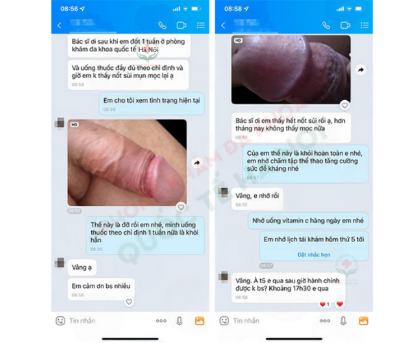 feedback chữa sùi mào gà