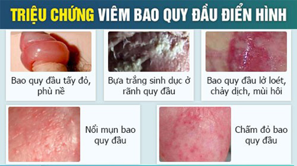 dấu hiệu viêm bao quy đầu