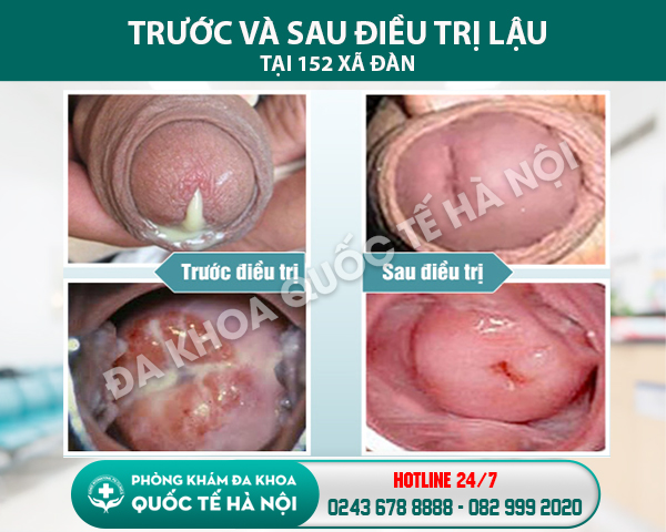 trước và sau chữa lậu
