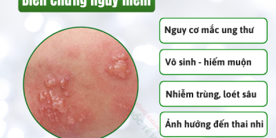 mun-rop-sinh-duc-co-ngua-khong-bac-si-canh-bao-dau-hieu-de-bi-nham-lan