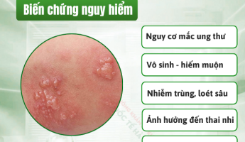 mun-rop-sinh-duc-co-nguy-hiem-khong-chuyen-gia-tren-30-nam-kinh-nghiem-giai-dap