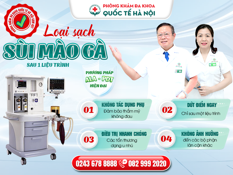 phương pháp ala pdt điều trị sùi mào gà
