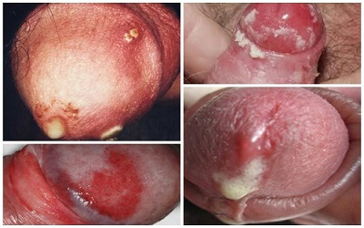 triệu chứng chảy mủ dương vật
