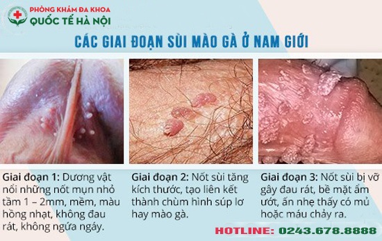 giai đoạn sùi mào gà ở nam